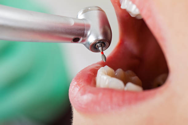 Best Emergency Dental Care for Broken or Chipped Teeth in Pu, HI